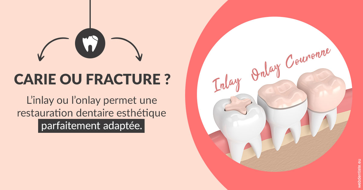 https://www.dentaire-carnot.com/T2 2023 - Carie ou fracture 2