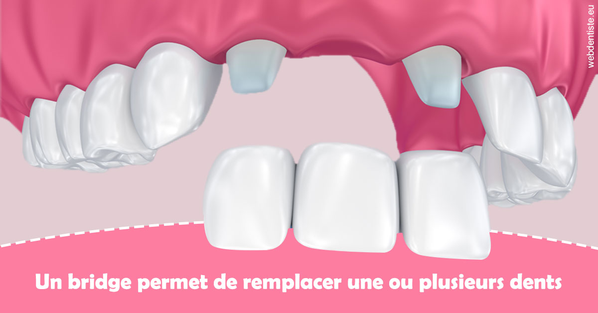 https://www.dentaire-carnot.com/Bridge remplacer dents 2