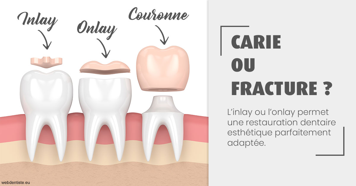 https://www.dentaire-carnot.com/T2 2023 - Carie ou fracture 1