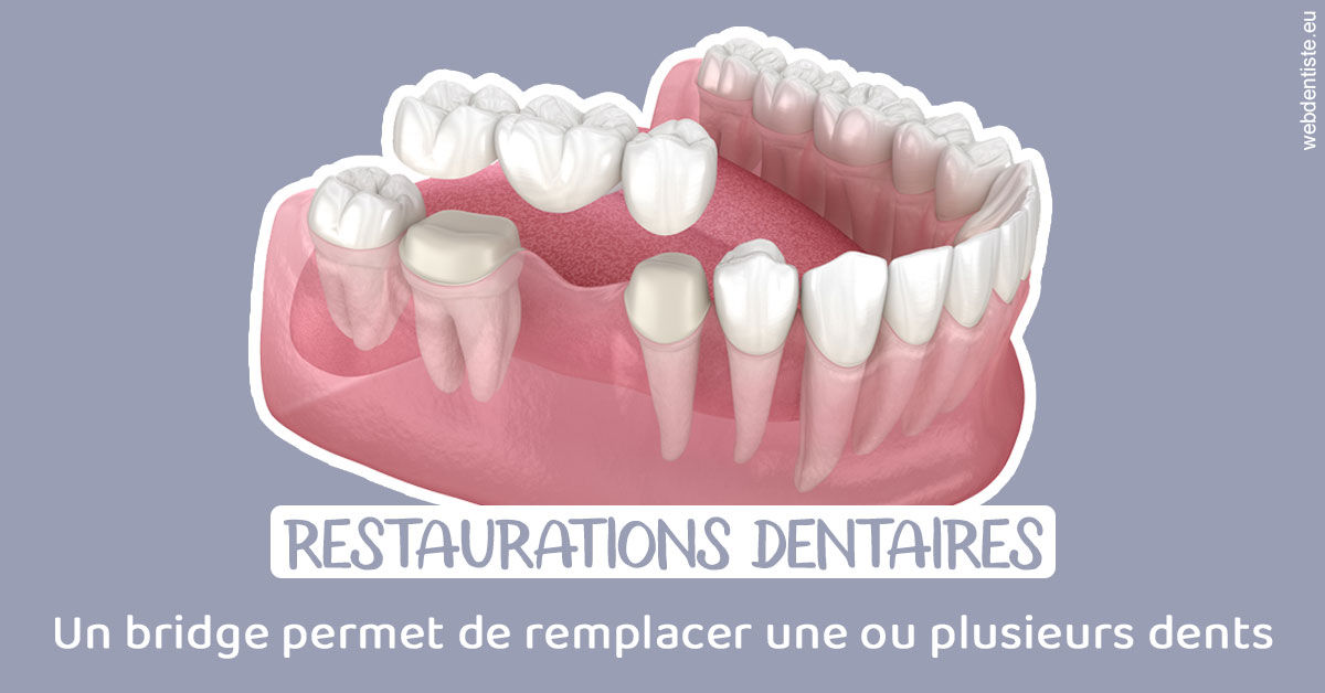 https://www.dentaire-carnot.com/Bridge remplacer dents 1