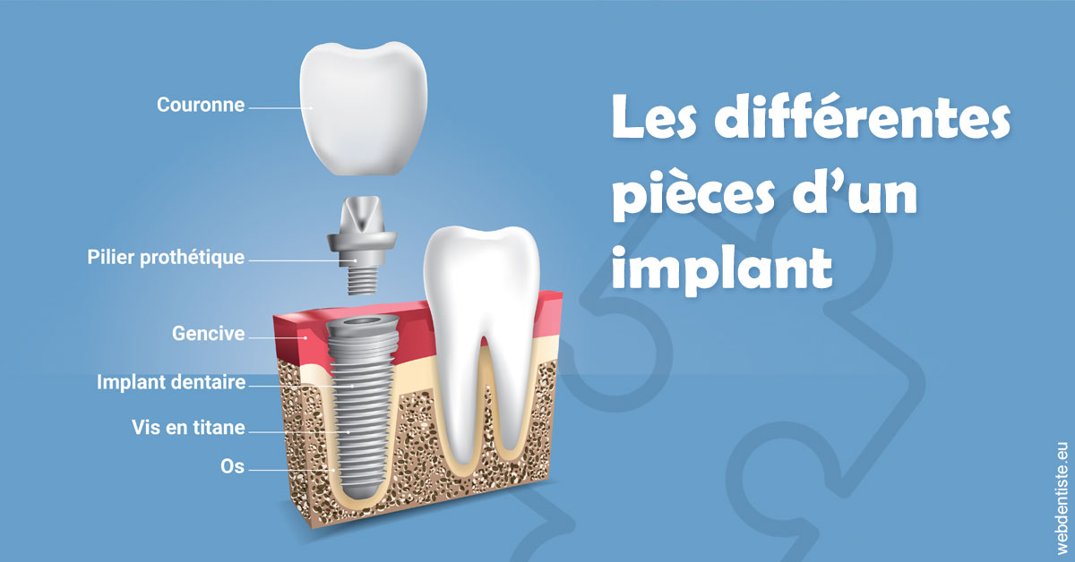 https://www.dentaire-carnot.com/Les différentes pièces d’un implant 1